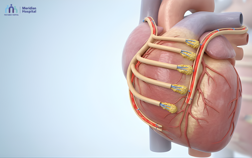 Angioplasty vs Bypass Surgery