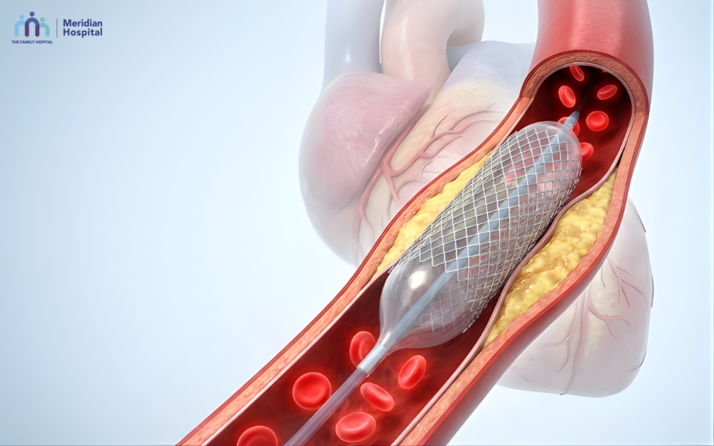 Coronary Artery Disease Treatment