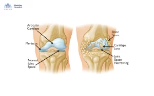 Joint Pain in Cold Season