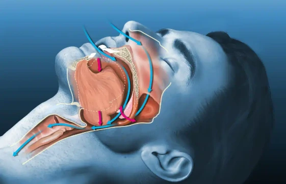Sleep Apnea and Heart Attack